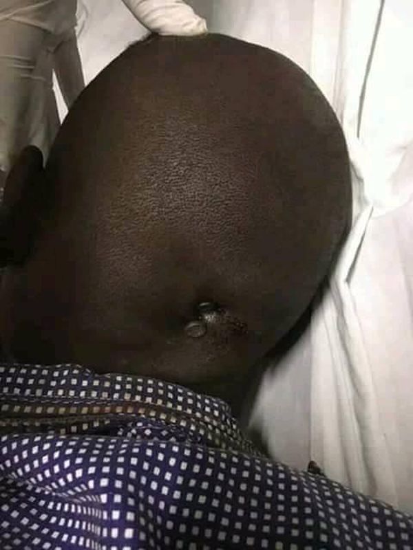 Husband Drives Nails Into Man’s Head After Catching Him With His Wife (Photo)