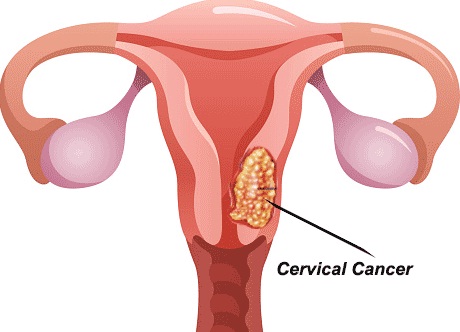 More women die from cervical cancer